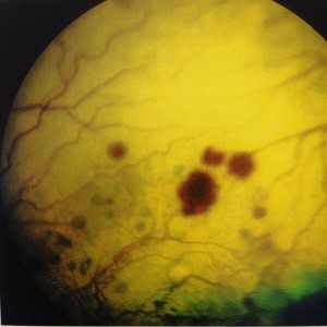 Retinal hemorrhages